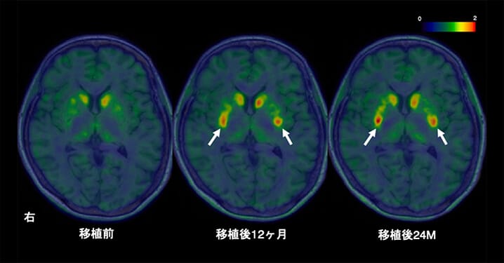 「iPS細胞由来ドパミン神経前駆細胞を⽤いたパーキンソン病治療に関する医師主導治験」において安全性と有効性が示唆